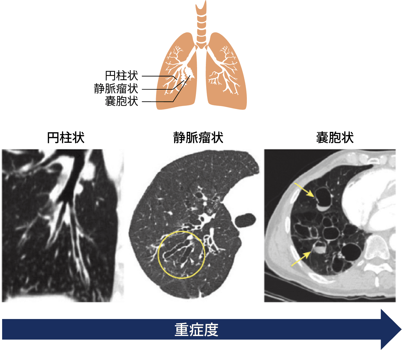 気管支拡張の形態