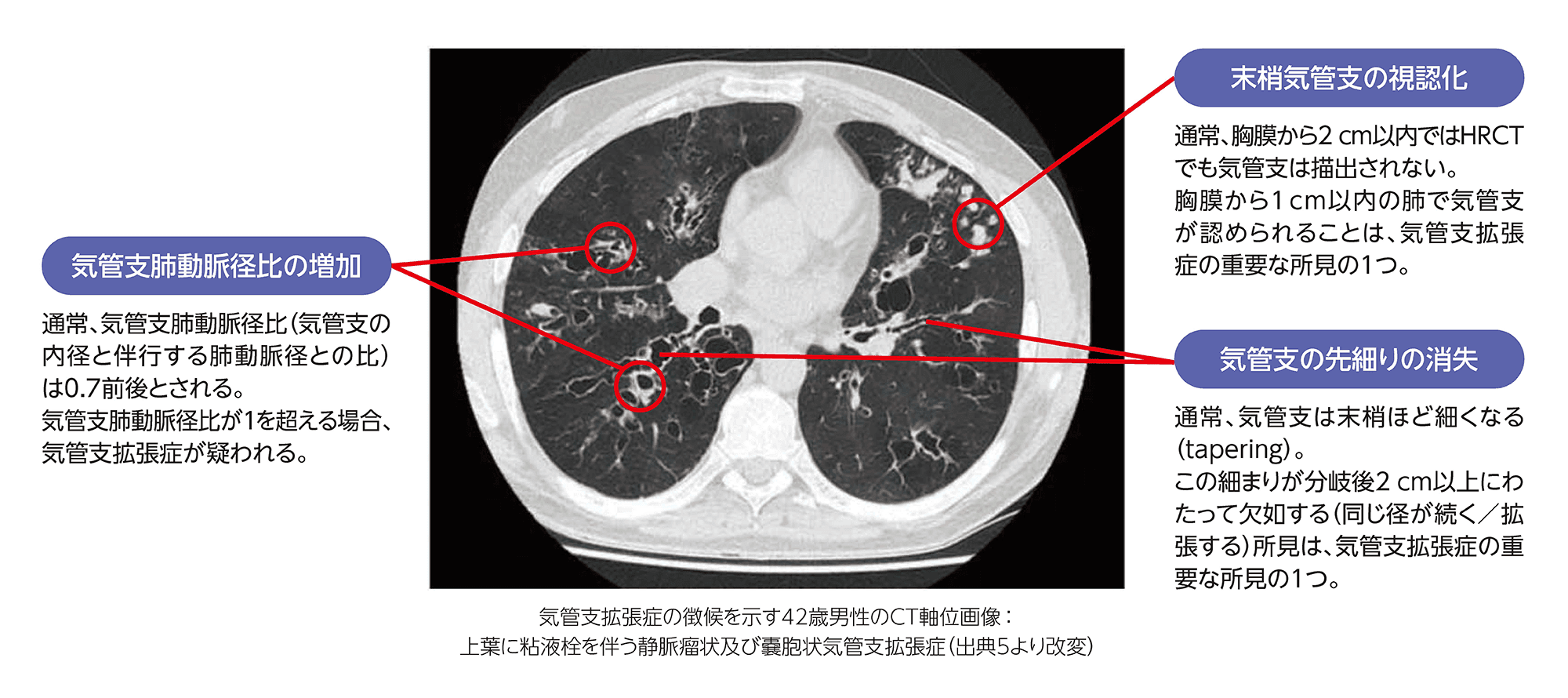 気管支拡張症患者の胸部CT所見