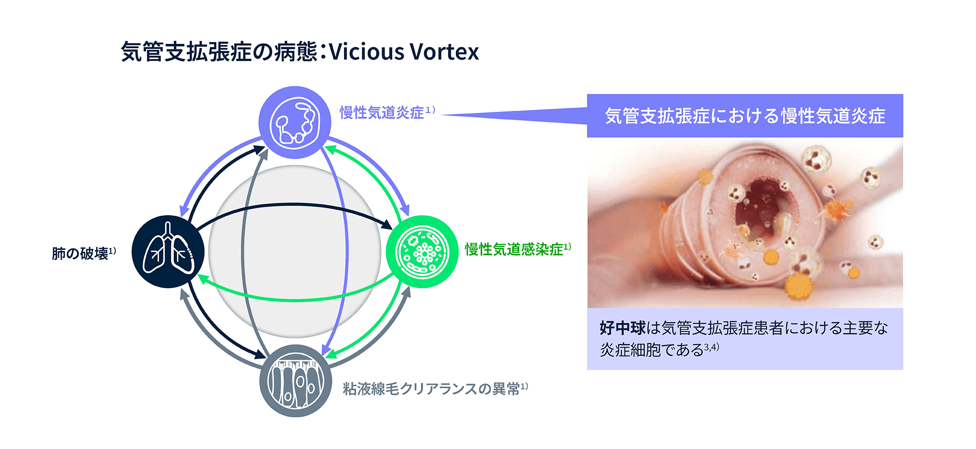 気管支拡張症の病態:Vicious Vortex