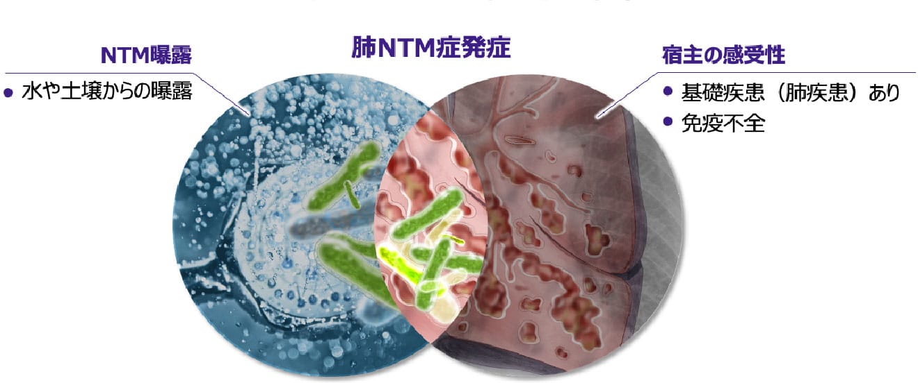 肺NTM症の発症:NTM曝露と宿主側の要因