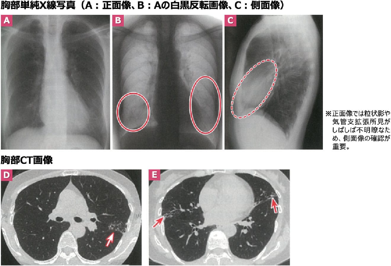 結節・気管支拡張型(中葉・舌区型/NB型)の典型像
